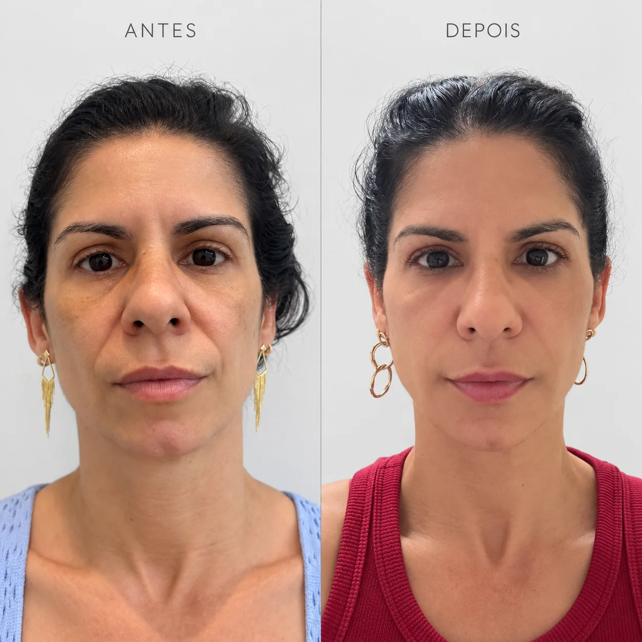 Registro clínico real 4 de rejuvenescimento facial em Itaquaquecetuba